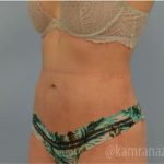 Liposuction Before & After Patient #2879