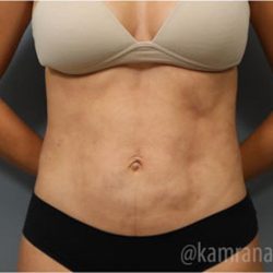 Liposuction Before & After Patient #2880