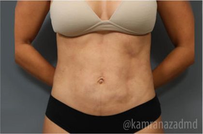 Liposuction Before & After Patient #2880