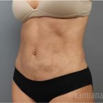 Liposuction Before & After Patient #2880