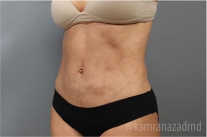 Liposuction Before & After Patient #2880