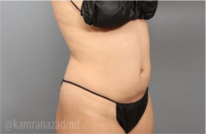 Liposuction Before & After Patient #2880