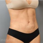 Liposuction Before & After Patient #2880