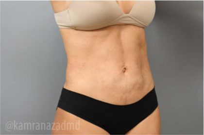 Liposuction Before & After Patient #2880