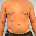 Male Liposuction Before & After Patient #2919