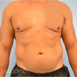 Male Liposuction Before & After Patient #2919