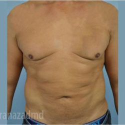 Male Liposuction Before & After Patient #2919