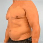 Male Liposuction Before & After Patient #2919