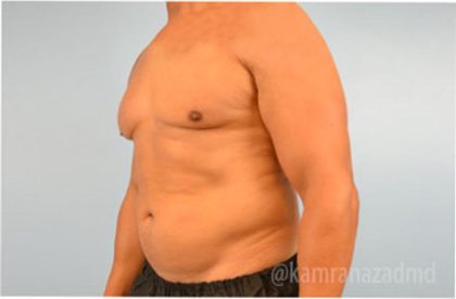 Male Liposuction Before & After Patient #2919