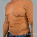 Male Liposuction Before & After Patient #2919