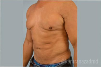 Male Liposuction Before & After Patient #2919