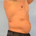 Male Liposuction Before & After Patient #2919