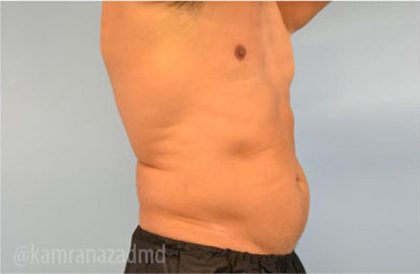 Male Liposuction Before & After Patient #2919