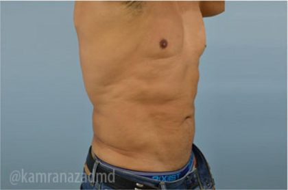 Male Liposuction Before & After Patient #2919