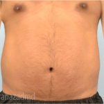Male Liposuction Before & After Patient #2920