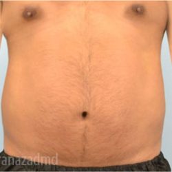 Male Liposuction Before & After Patient #2920