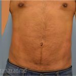Male Liposuction Before & After Patient #2920