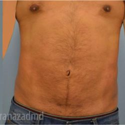 Male Liposuction Before & After Patient #2920