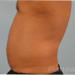 Male Liposuction Before & After Patient #2920