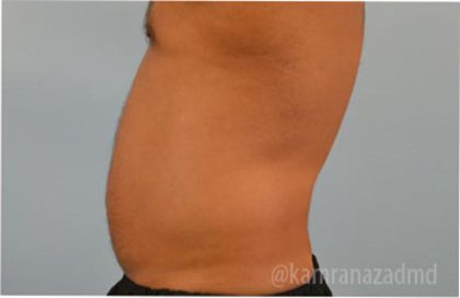 Male Liposuction Before & After Patient #2920