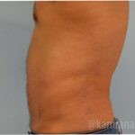 Male Liposuction Before & After Patient #2920