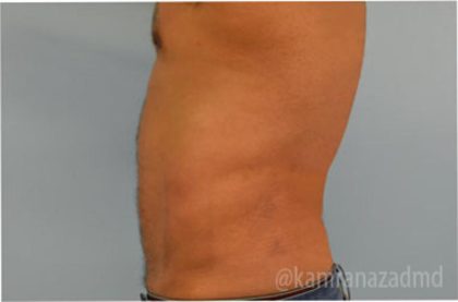Male Liposuction Before & After Patient #2920