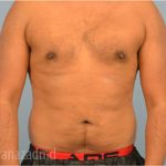 Male Liposuction Before & After Patient #2921
