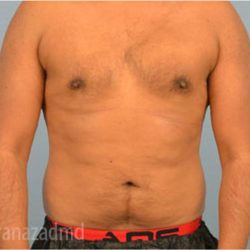 Male Liposuction Before & After Patient #2921