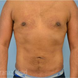 Male Liposuction Before & After Patient #2921