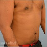 Male Liposuction Before & After Patient #2921