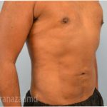 Male Liposuction Before & After Patient #2921