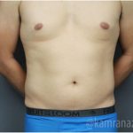 Male Liposuction Before & After Patient #2922