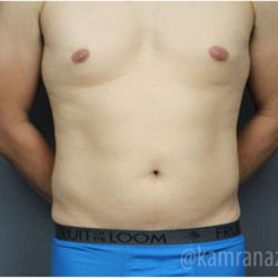 Male Liposuction Before & After Patient #2922