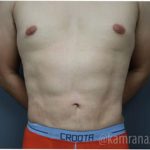 Male Liposuction Before & After Patient #2922