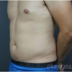 Male Liposuction Before & After Patient #2922