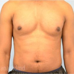 Male Liposuction Before & After Patient #2923