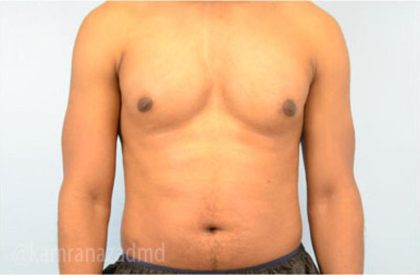 Male Liposuction Before & After Patient #2923