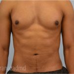 Male Liposuction Before & After Patient #2923