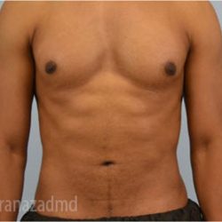 Male Liposuction Before & After Patient #2923
