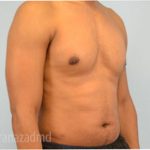 Male Liposuction Before & After Patient #2923