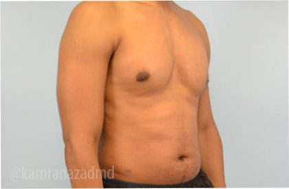 Male Liposuction Before & After Patient #2923
