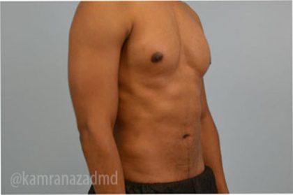 Male Liposuction Before & After Patient #2923