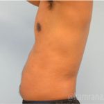 Male Liposuction Before & After Patient #2923