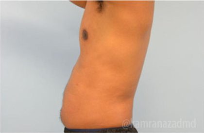 Male Liposuction Before & After Patient #2923