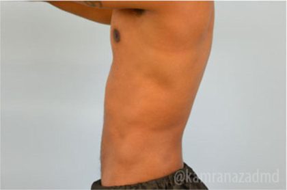 Male Liposuction Before & After Patient #2923