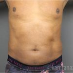 Male Liposuction Before & After Patient #2924