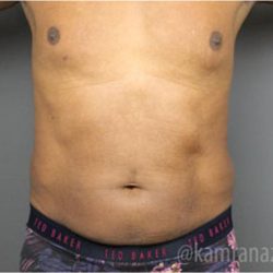 Male Liposuction Before & After Patient #2924
