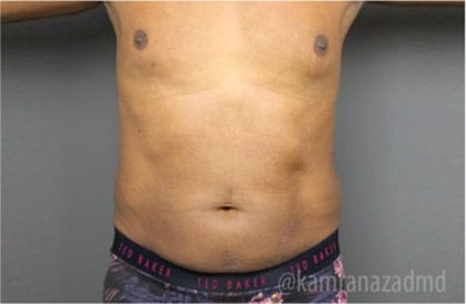Male Liposuction Before & After Patient #2924