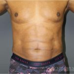 Male Liposuction Before & After Patient #2924