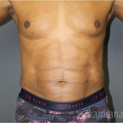Male Liposuction Before & After Patient #2924